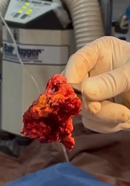 Neurosurgeon holding a brain tumour removed during Sierra Leone's first successful brain tumour surgery at Connaught Hospital.